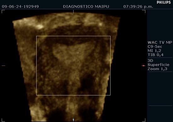 Resultado de imagen de ecografia de los musculos del cuello uterino