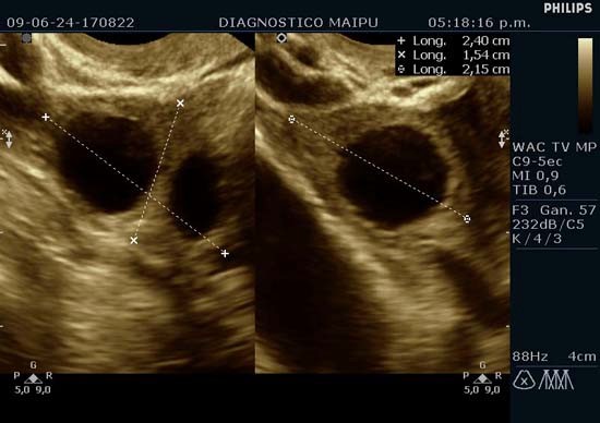 Para que sirve la ecografia doppler obstetrica