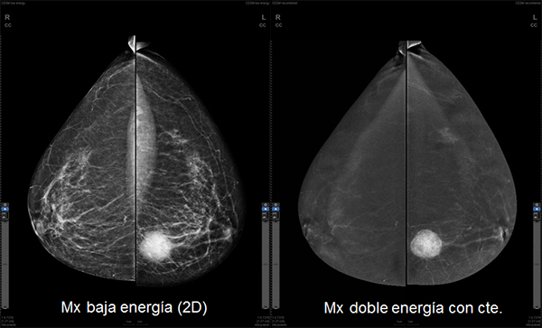 mamografia con contraste 1