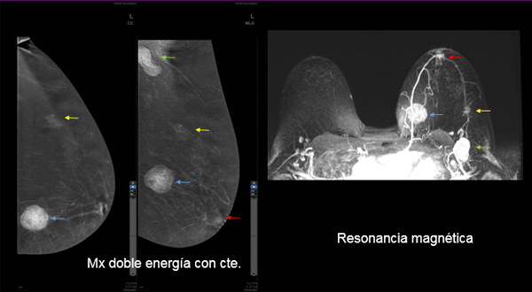 mamografia con contraste 3