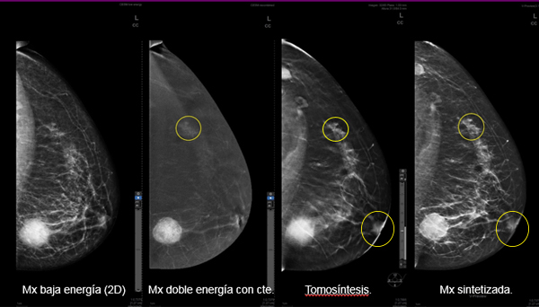 mamografia con contraste2
