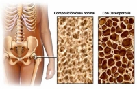 Osteoporosis: Una enfermedad silenciosa